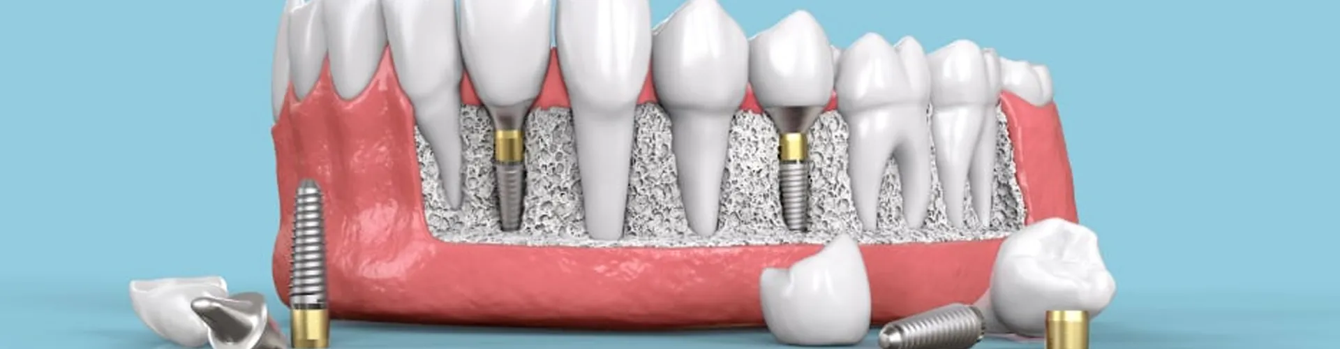 3D illustration of a denture with dental implants.