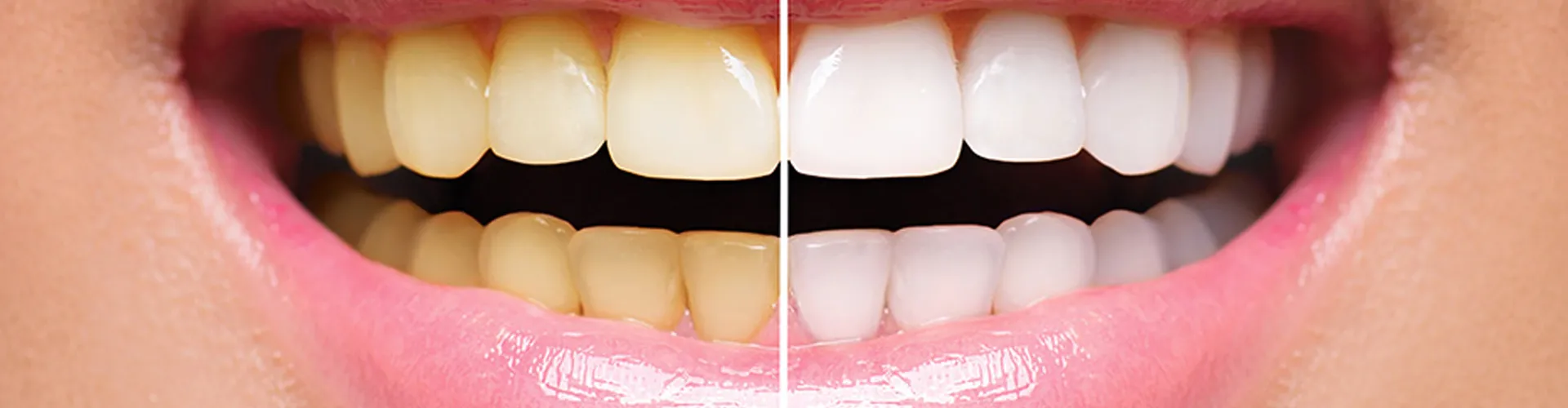 Smile comparison showing half white teeth and half yellow teeth.