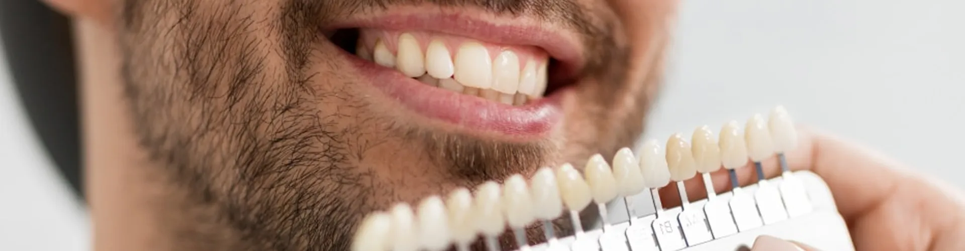 Man smiling with veneers displayed in front of his teeth.