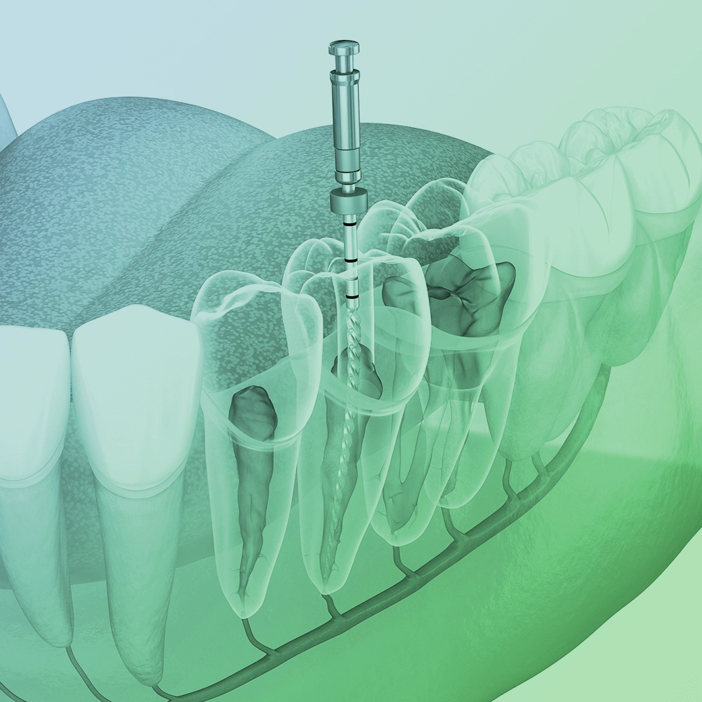 3D illustration of a tooth being drilled for a root canal.