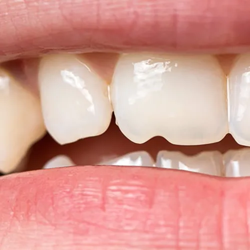 Mouth with a chipped tooth.