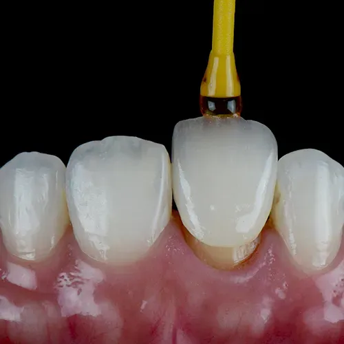 Tool placing a front tooth crown.