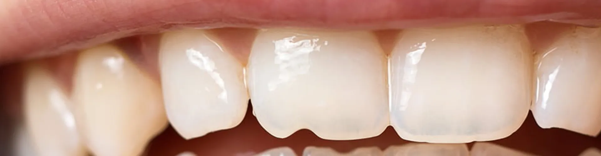 Mouth with a chipped tooth.