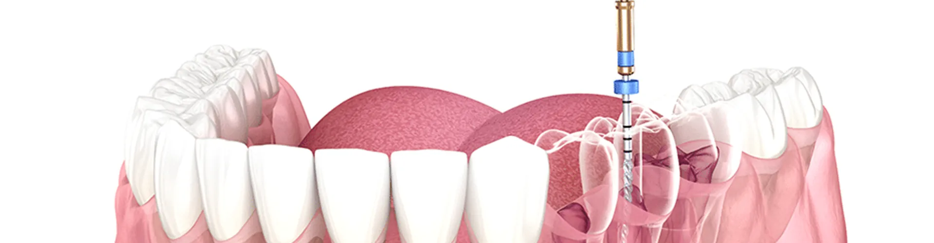 3D illustration of a tooth undergoing a root canal treatment.