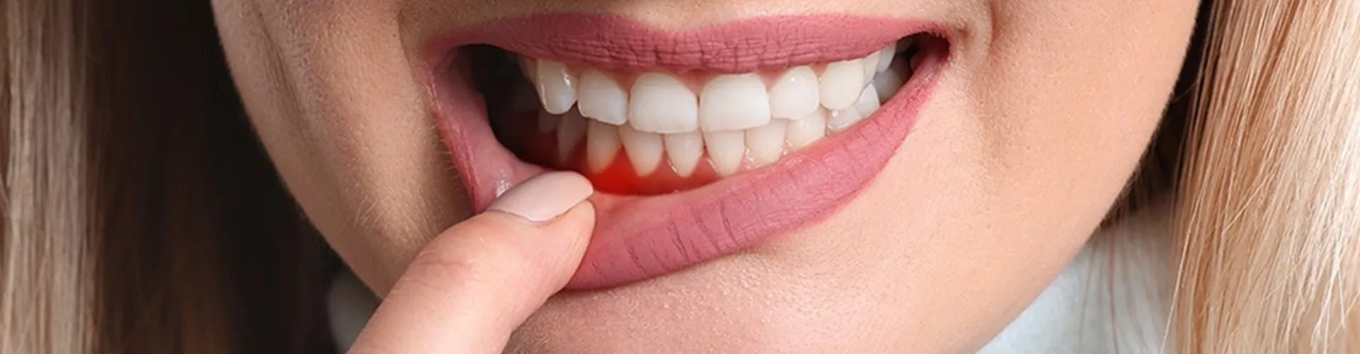 A woman pulling down her bottom lip to show irritated gums.