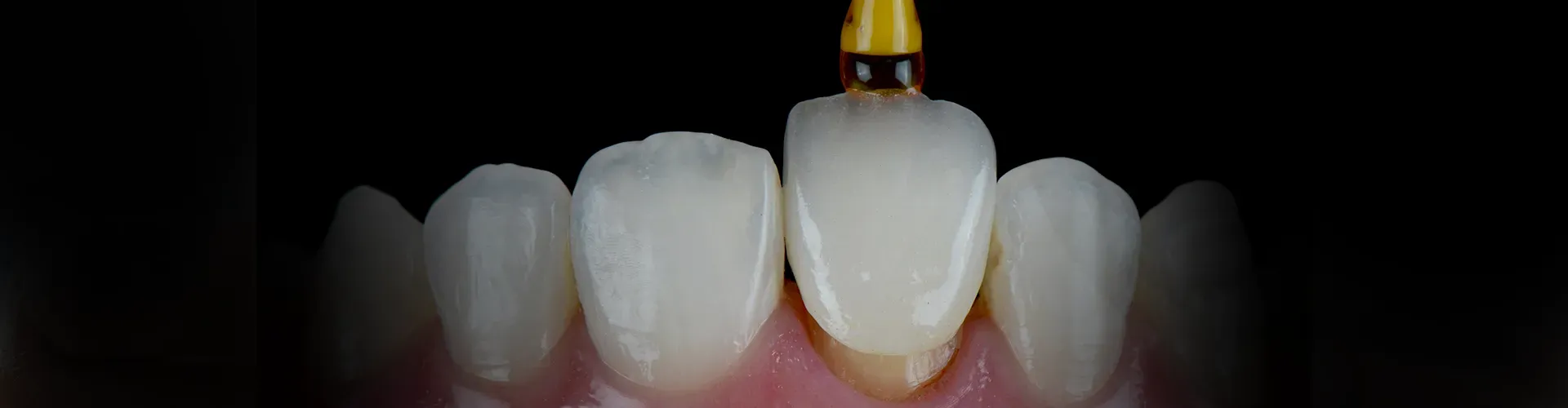 Tool placing a front tooth crown.