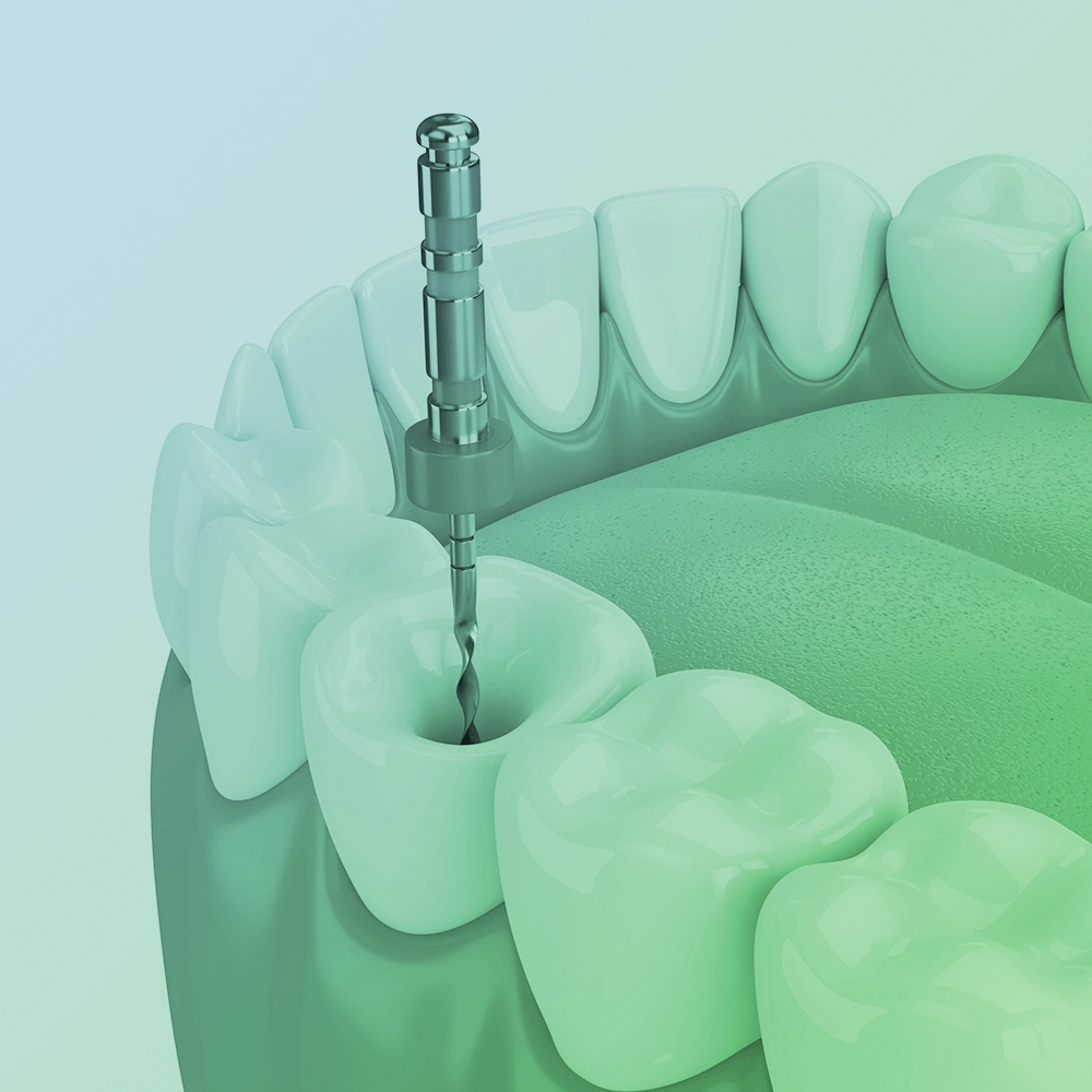 3D illustration of a tooth being drilled for a root canal.